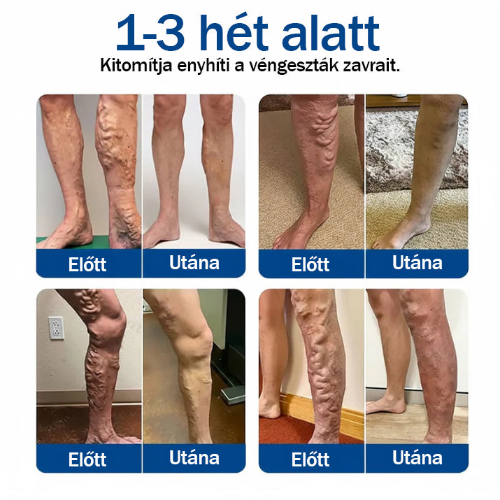 🍎🍎Medistart® Visszérápoló Mikrotűs Gondozó Tapasz ⚡ Azonnali Megkönnyebbülés, Hosszú Távú Eredmények