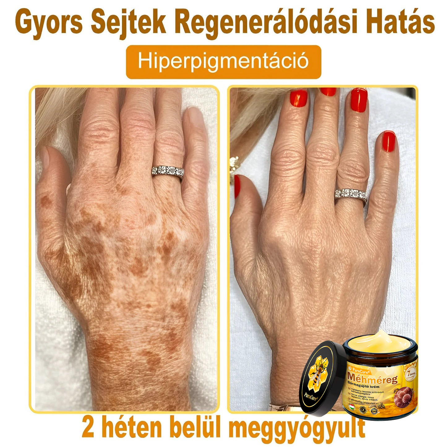 👨‍⚕‍🐝 𝐏𝐮𝐫𝐚𝐂𝐮𝐫𝐞® 𝐌é𝐡𝐦é𝐫𝐞𝐠 𝐁ő𝐫 𝐇𝐞𝐥𝐲𝐫𝐞á𝐥𝐥í𝐭ó 𝐊𝐫é𝐦 (𝐂𝐄 𝐓𝐚𝐧ú𝐬í𝐭𝐯á𝐧𝐲)👍✅