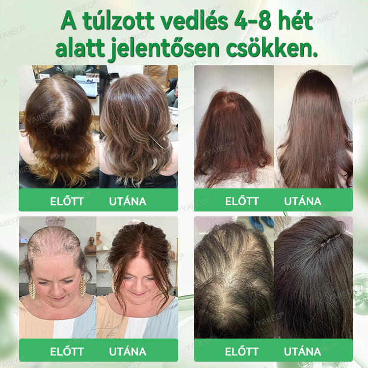 🍌𝐘𝐀𝐈𝐈𝐄𝐎® 𝑭á𝒋𝒅𝒂𝒍𝒐𝒎𝒎𝒆𝒏𝒕𝒆𝒔 𝑴𝒊𝒌𝒓𝒐𝒊𝒏𝒇ú𝒛𝒊ó𝒔 𝑹𝒆𝒏𝒅𝒔𝒛𝒆𝒓 Mélyen ható DHT-blokkolás, hajhagymák újraaktiválása és látható hajnövekedés