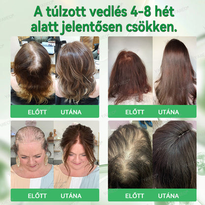 🍌𝐘𝐀𝐈𝐈𝐄𝐎® 𝑭á𝒋𝒅𝒂𝒍𝒐𝒎𝒎𝒆𝒏𝒕𝒆𝒔 𝑴𝒊𝒌𝒓𝒐𝒊𝒏𝒇ú𝒛𝒊ó𝒔 𝑹𝒆𝒏𝒅𝒔𝒛𝒆𝒓 Mélyen ható DHT-blokkolás, hajhagymák újraaktiválása és látható hajnövekedés