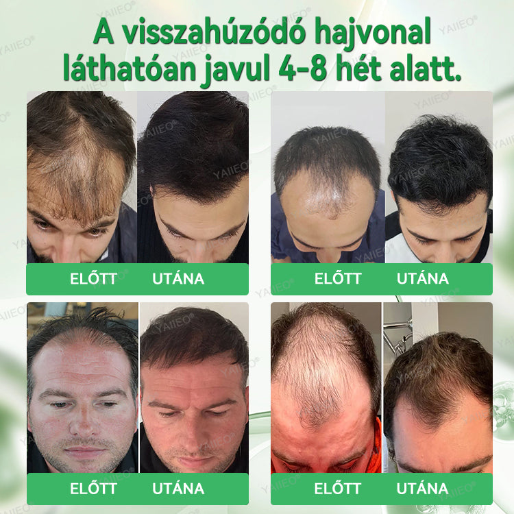 🍌𝐘𝐀𝐈𝐈𝐄𝐎® 𝑭á𝒋𝒅𝒂𝒍𝒐𝒎𝒎𝒆𝒏𝒕𝒆𝒔 𝑴𝒊𝒌𝒓𝒐𝒊𝒏𝒇ú𝒛𝒊ó𝒔 𝑹𝒆𝒏𝒅𝒔𝒛𝒆𝒓 Mélyen ható DHT-blokkolás, hajhagymák újraaktiválása és látható hajnövekedés