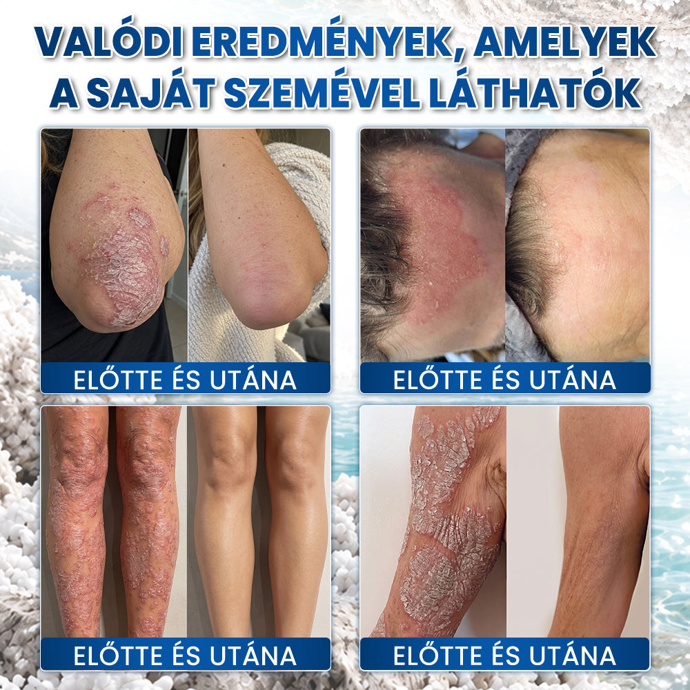 🌿🌿Medistart® PSZORIÁZIS SPECIÁLIS BŐRÁPOLÓ