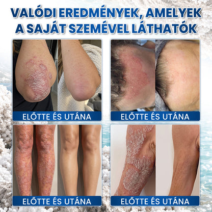 🌿🌿Medistart® PSZORIÁZIS SPECIÁLIS BŐRÁPOLÓ