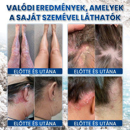 🌿🌿Medistart® PSZORIÁZIS SPECIÁLIS BŐRÁPOLÓ