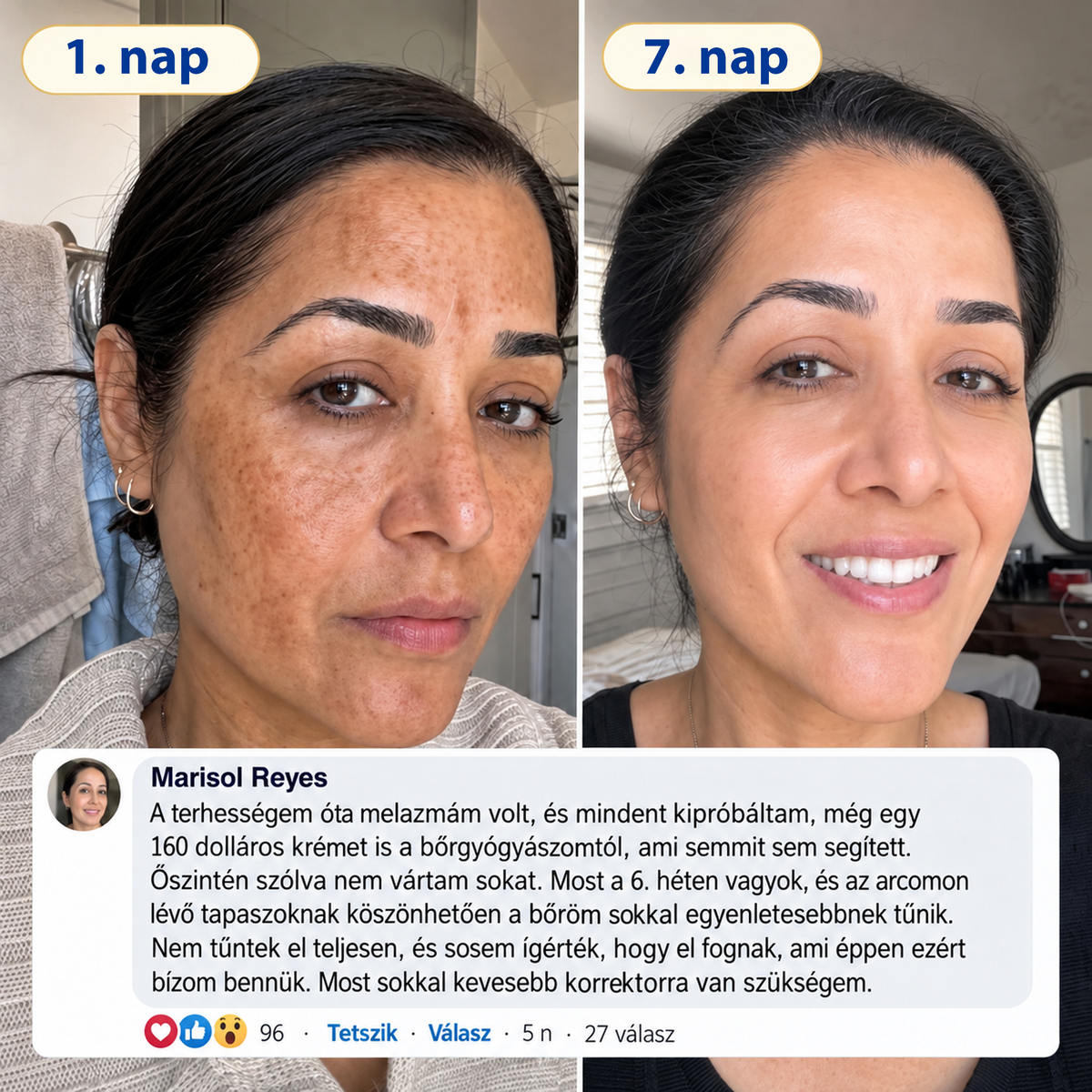 ❄️𝑯𝒊𝒗𝒂𝒕𝒂𝒍𝒐𝒔 𝑼̈𝒛𝒍𝒆𝒕 | 𝐔́𝐣! ✨ Medistart® 𝐊𝐮𝐫𝐤𝐮𝐦𝐚 × 𝐊𝐨𝐣𝐢𝐧𝐬𝐚𝐯 𝐄́𝐣𝐬𝐳𝐚𝐤𝐚𝐢 Bőrfiatalító 𝐊𝐫𝐞́𝐦— 𝐇𝐚𝐥𝐯𝐚́𝐧𝐲𝐢́𝐭𝐬𝐝 𝐚 𝐦𝐚𝐤𝐚𝐜𝐬 𝐬𝐨̈𝐭𝐞́𝐭 𝐟𝐨𝐥𝐭𝐨𝐤𝐚𝐭 𝐞́𝐬 𝐬𝐢𝐦𝐢́𝐭𝐬𝐝 𝐤𝐢 𝐚 𝐥𝐚́𝐭𝐡𝐚𝐭𝐨́ 𝐫𝐚́𝐧𝐜𝐨𝐤𝐚𝐭 𝐚𝐥𝐯𝐚́𝐬 𝐤𝐨̈𝐳𝐛𝐞𝐧 🌙 ✅ 𝐄́𝐣𝐬𝐳𝐚𝐤𝐚́𝐧𝐤𝐞́𝐧𝐭 𝐞𝐠𝐲 𝐥𝐞́𝐩𝐞́𝐬 · 𝐋𝐚́𝐭𝐡𝐚𝐭𝐨́ 𝐯𝐚́𝐥𝐭𝐨𝐳𝐚́𝐬 𝟕 𝐞́𝐣𝐬𝐳𝐚𝐤𝐚 𝐚𝐥𝐚𝐭𝐭 💯