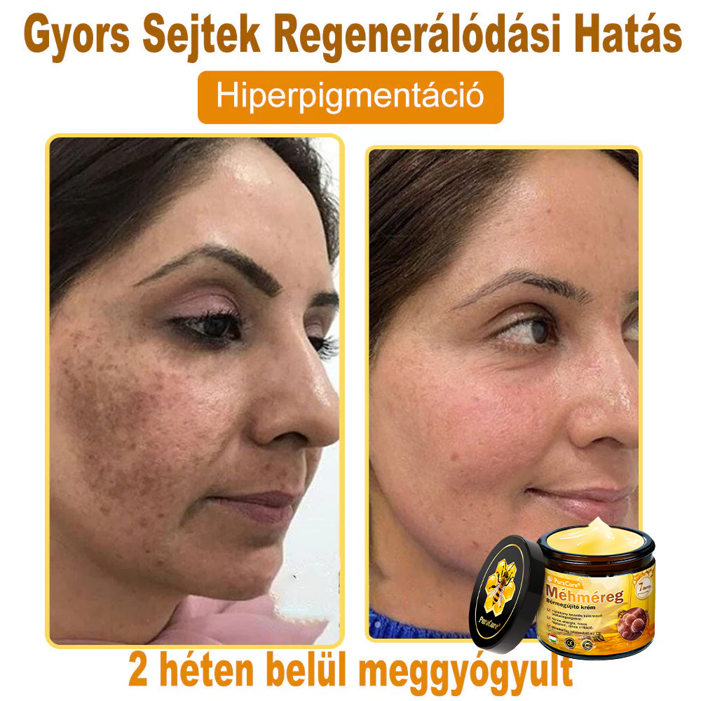 👨‍⚕‍🐝 𝐏𝐮𝐫𝐚𝐂𝐮𝐫𝐞® 𝐌é𝐡𝐦é𝐫𝐞𝐠 𝐁ő𝐫 𝐇𝐞𝐥𝐲𝐫𝐞á𝐥𝐥í𝐭ó 𝐊𝐫é𝐦 (𝐂𝐄 𝐓𝐚𝐧ú𝐬í𝐭𝐯á𝐧𝐲)👍✅
