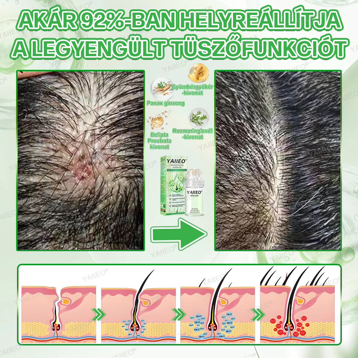 🍌𝐘𝐀𝐈𝐈𝐄𝐎® 𝑭á𝒋𝒅𝒂𝒍𝒐𝒎𝒎𝒆𝒏𝒕𝒆𝒔 𝑴𝒊𝒌𝒓𝒐𝒊𝒏𝒇ú𝒛𝒊ó𝒔 𝑹𝒆𝒏𝒅𝒔𝒛𝒆𝒓 Mélyen ható DHT-blokkolás, hajhagymák újraaktiválása és látható hajnövekedés