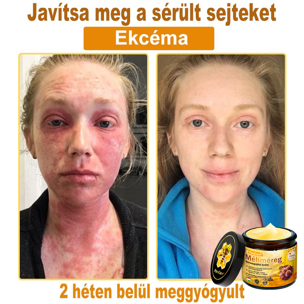 👨‍⚕‍🐝 𝐏𝐮𝐫𝐚𝐂𝐮𝐫𝐞® 𝐌é𝐡𝐦é𝐫𝐞𝐠 𝐁ő𝐫 𝐇𝐞𝐥𝐲𝐫𝐞á𝐥𝐥í𝐭ó 𝐊𝐫é𝐦 (𝐂𝐄 𝐓𝐚𝐧ú𝐬í𝐭𝐯á𝐧𝐲)👍✅