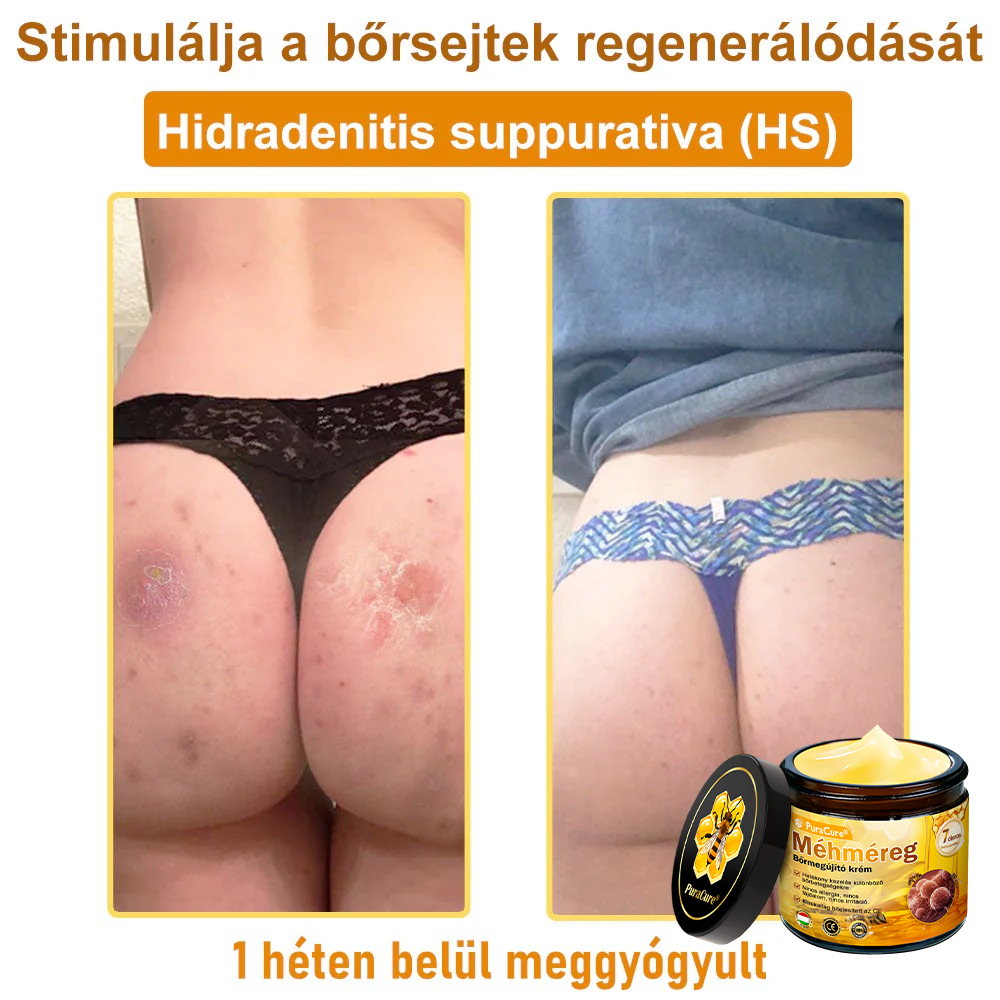 👨‍⚕‍🐝 𝐏𝐮𝐫𝐚𝐂𝐮𝐫𝐞® 𝐌é𝐡𝐦é𝐫𝐞𝐠 𝐁ő𝐫 𝐇𝐞𝐥𝐲𝐫𝐞á𝐥𝐥í𝐭ó 𝐊𝐫é𝐦 (𝐂𝐄 𝐓𝐚𝐧ú𝐬í𝐭𝐯á𝐧𝐲)👍✅