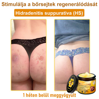 👨‍⚕‍🐝 𝐏𝐮𝐫𝐚𝐂𝐮𝐫𝐞® 𝐌é𝐡𝐦é𝐫𝐞𝐠 𝐁ő𝐫 𝐇𝐞𝐥𝐲𝐫𝐞á𝐥𝐥í𝐭ó 𝐊𝐫é𝐦 (𝐂𝐄 𝐓𝐚𝐧ú𝐬í𝐭𝐯á𝐧𝐲)👍✅
